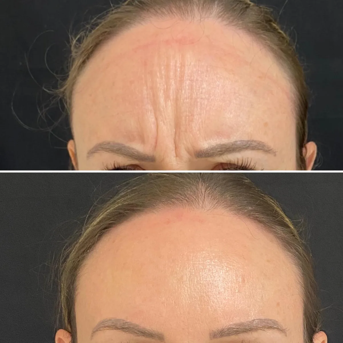 Harmonização facial caso 1