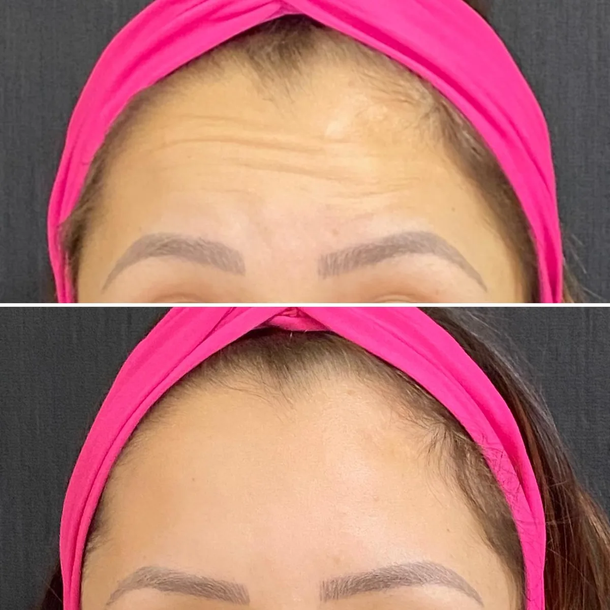Harmonização facial caso 2