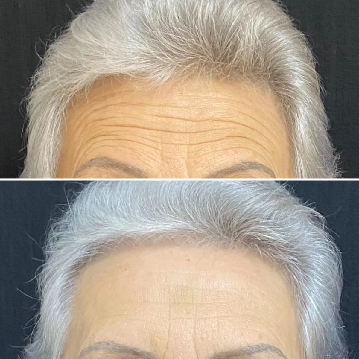 Harmonização facial caso 3