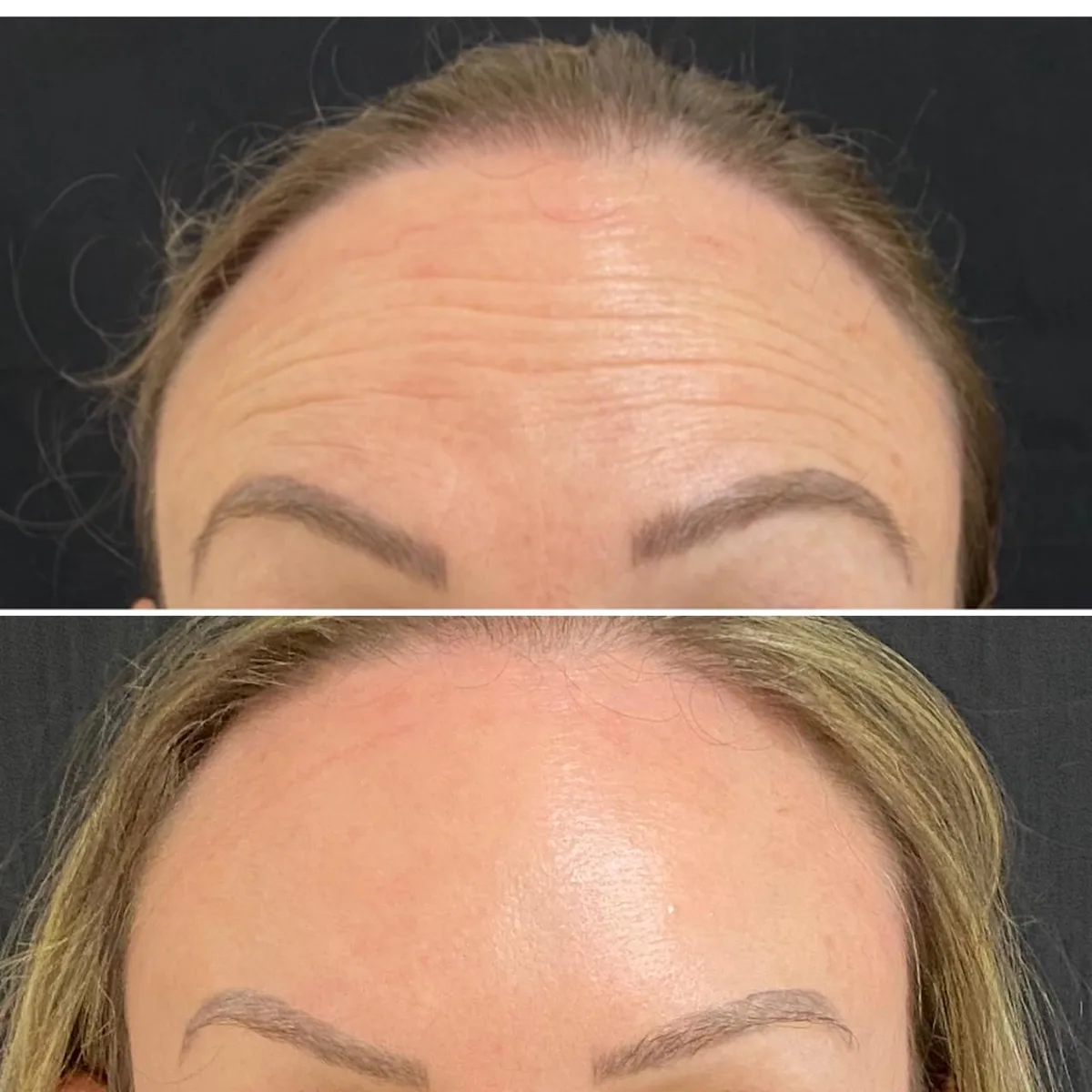 Harmonização facial caso 4