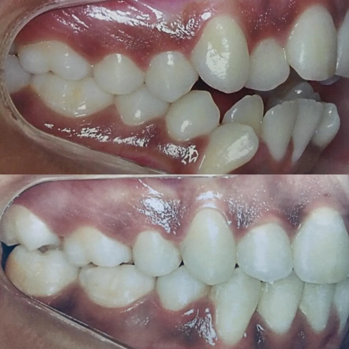 Invisalign caso 1