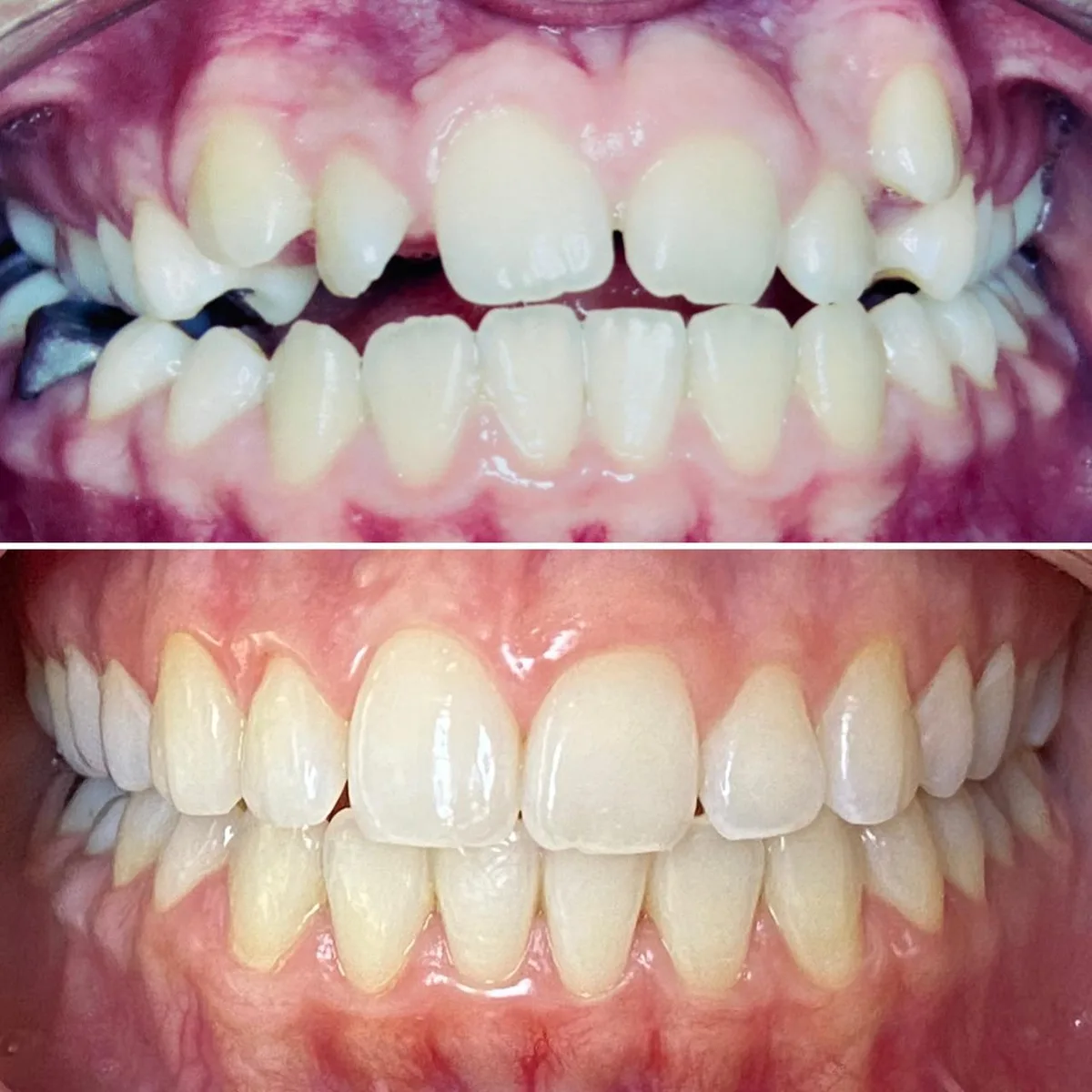 Invisalign caso 2