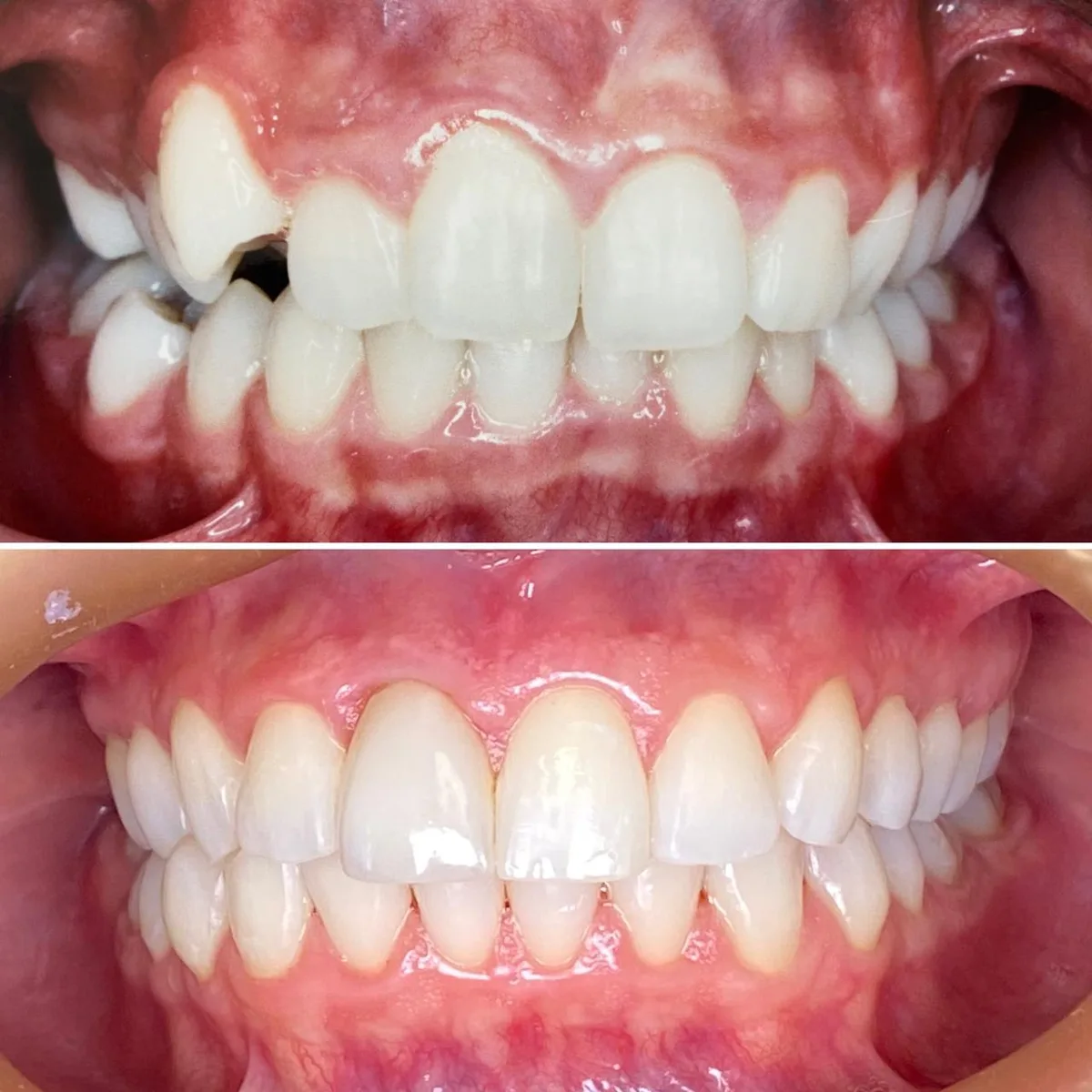 Invisalign caso 3