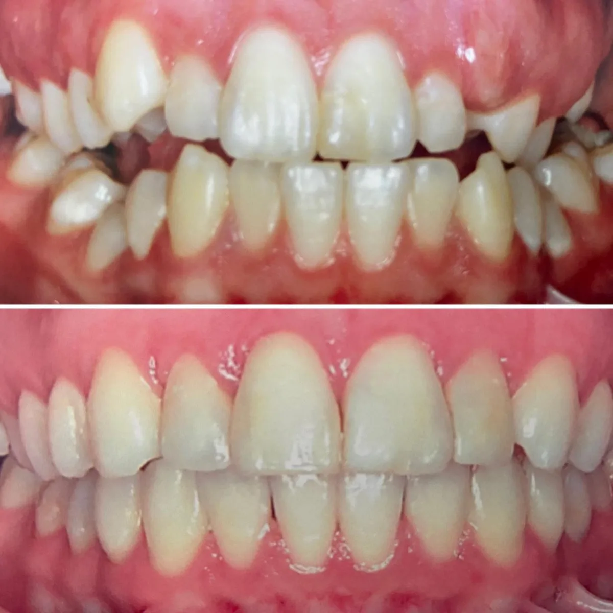Invisalign caso 4